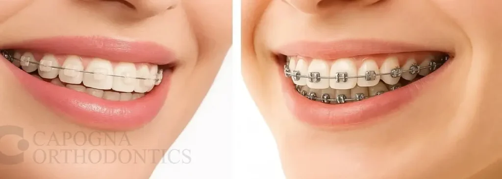 Best Ceramic Braces vs Classic Braces