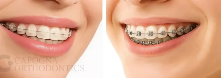 Best Ceramic Braces vs Classic Braces