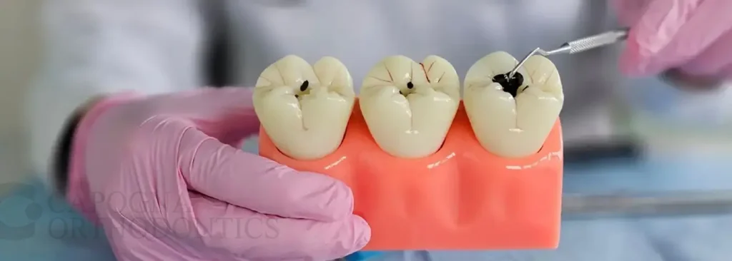Tooth Cavities