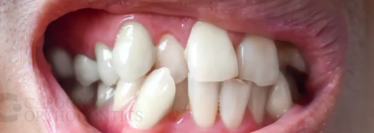 Causes Crooked Teeth